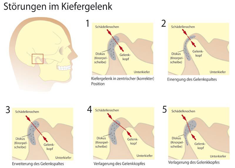 Was ist CMD? - Zahnarzt-Praxis Bremen, Dr. Natalia Marquardt